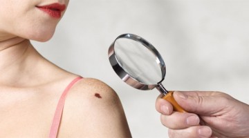 Ранняя диагностика и профилактика меланомы кожи